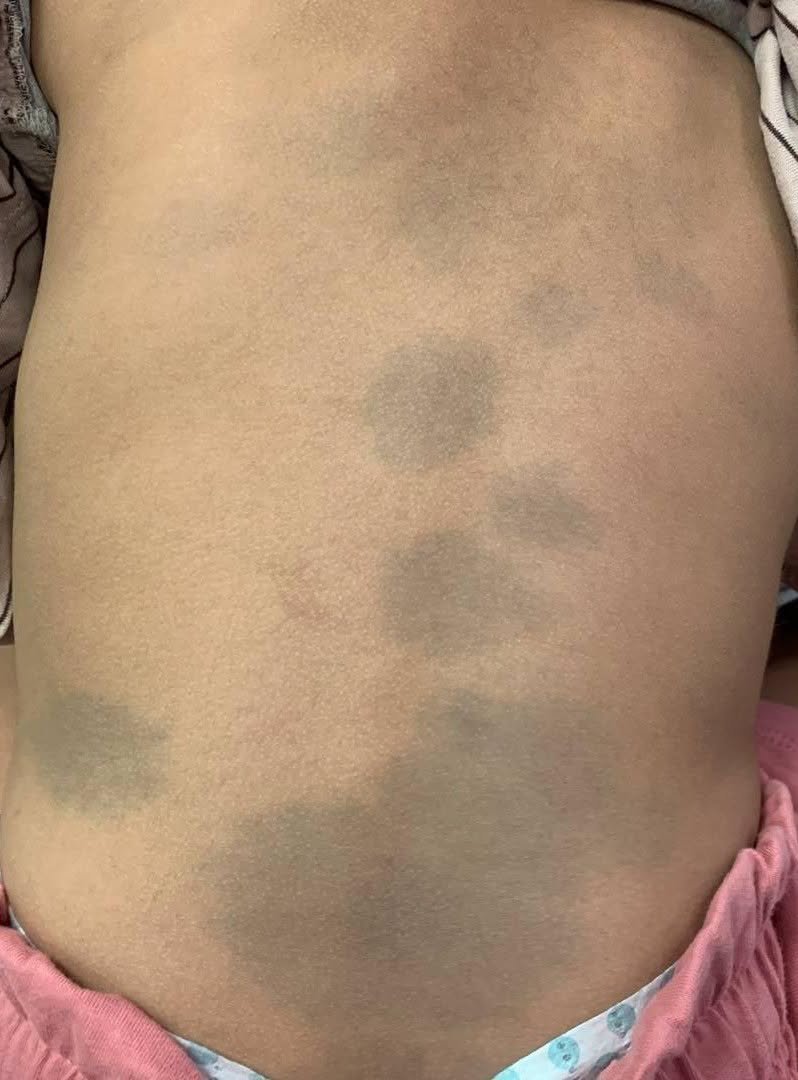 المرحلة الثانية: طفح المواليد الطبيعي - البقع الزرقاء العميقة Congenital dermal melanocytosis (6/7)