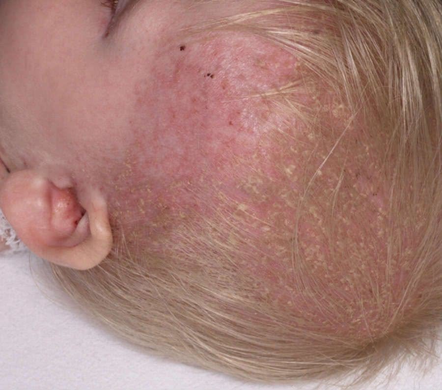 المرحلة الثالثة: مشاكل الرضّع الشائعة - قبعة المهد المقنّعة (6/6) Langerhans Cell Histiocytosis / LCH