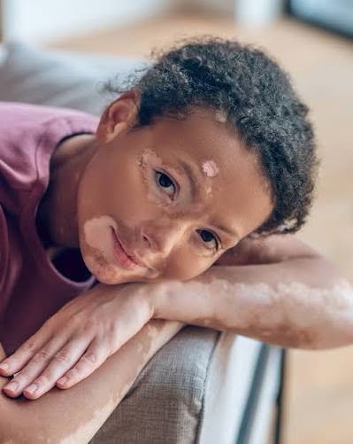 المرحلة الرابعة: الطفولة المبكرة - البهاق عند الأطفال: مرض جلدي بثقل نفسي (Vitiligo) (٨/١٠)