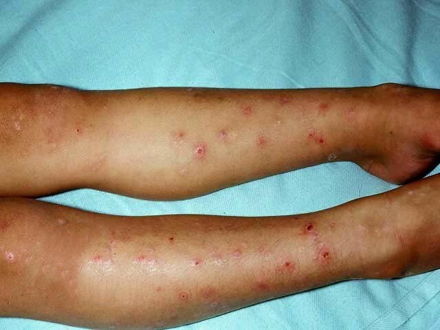 المرحلة الرابعة: الطفولة المبكرة - لدغة الناموسة البتورم زي البيضة (Papular urticaria) (٩/١٠)