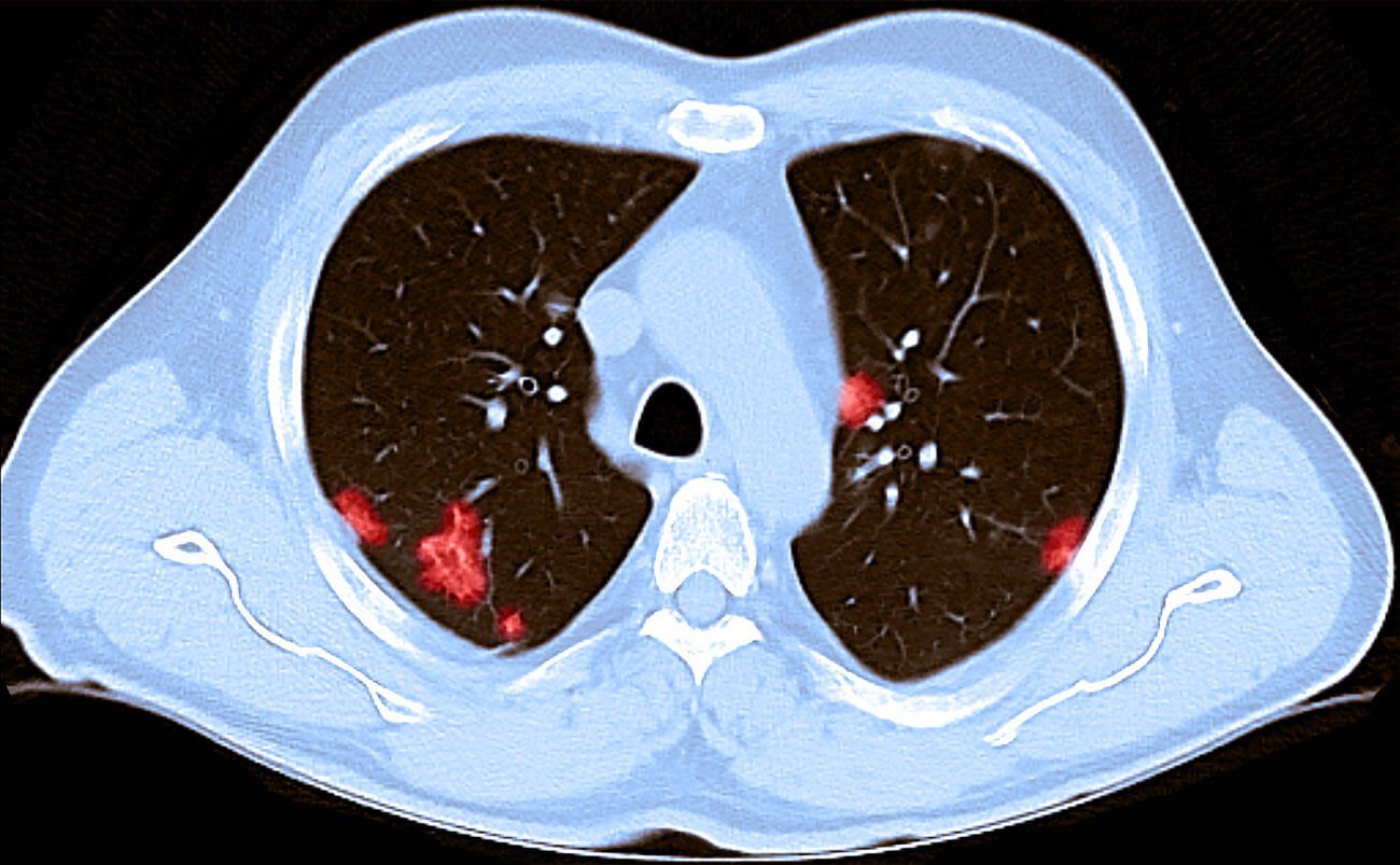 عن اللاأعراضيين Asymptomatic patients (المصابين بالمرض دون ظهور أي أعراض عليهم…