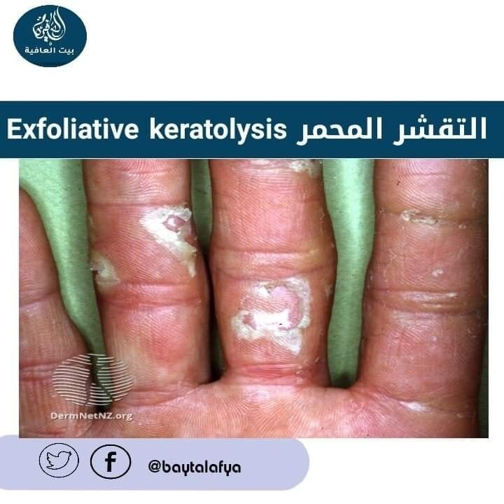 التقشر المحمر Exfoliative keratolysis