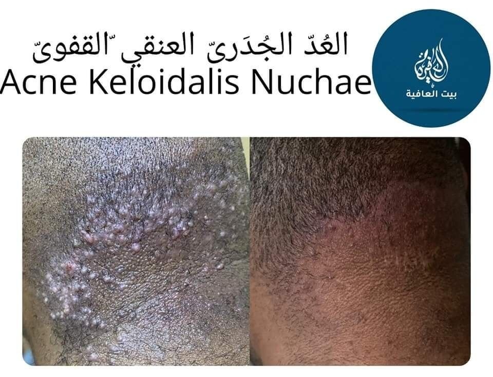 العد الجدري العنقي القفوي