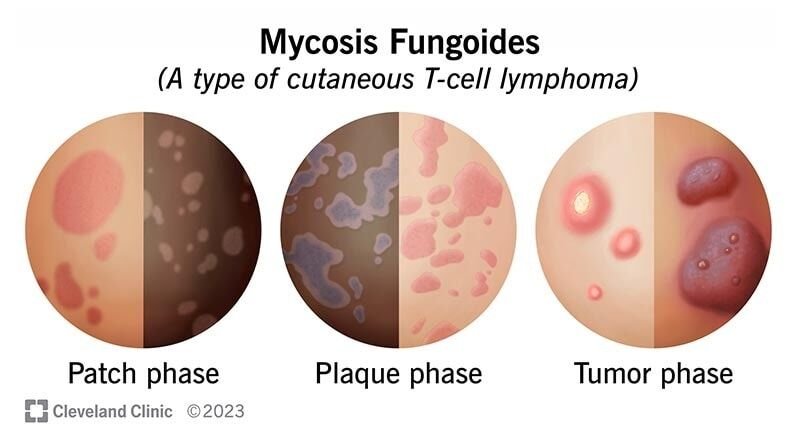 اليوم سنتحدث عن حالة جلدية نادرة تُعرف بـ "الفطار الفطراني" (Mycosis fungoi