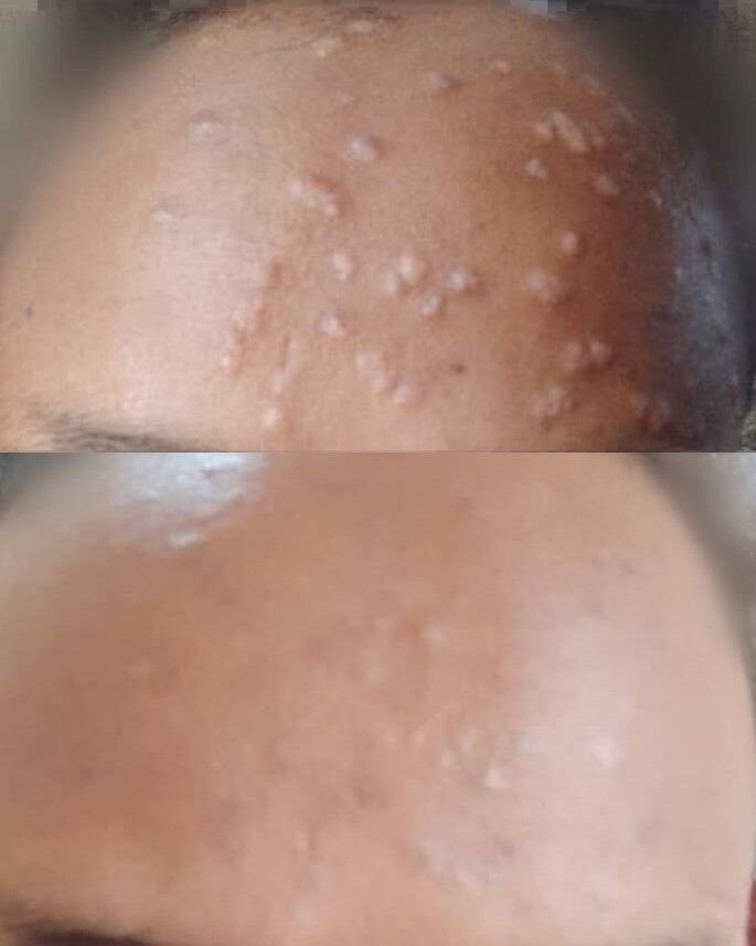 الثآليل المسطحة وإستجابة جميلة لعلاج مختلف