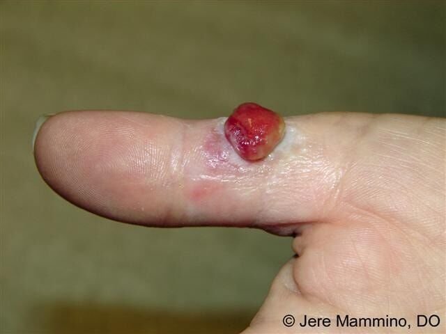🧬 الورم الحُبيبي القيحي (Pyogenic Granuloma)