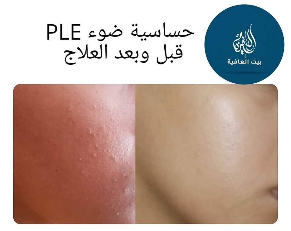 الطفح الضوئي متعدد الأشكال Polymorphic light eruption