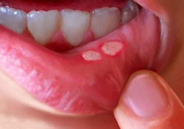 تسمى أيضًا القروح القلاعية (Aphthous Ulcers)