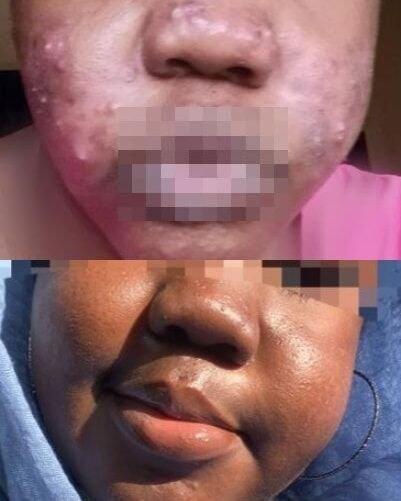 الأمراض المزمنة الطابع مثل حب الشباب تسبب إزعاجا كبيرا للمرضى