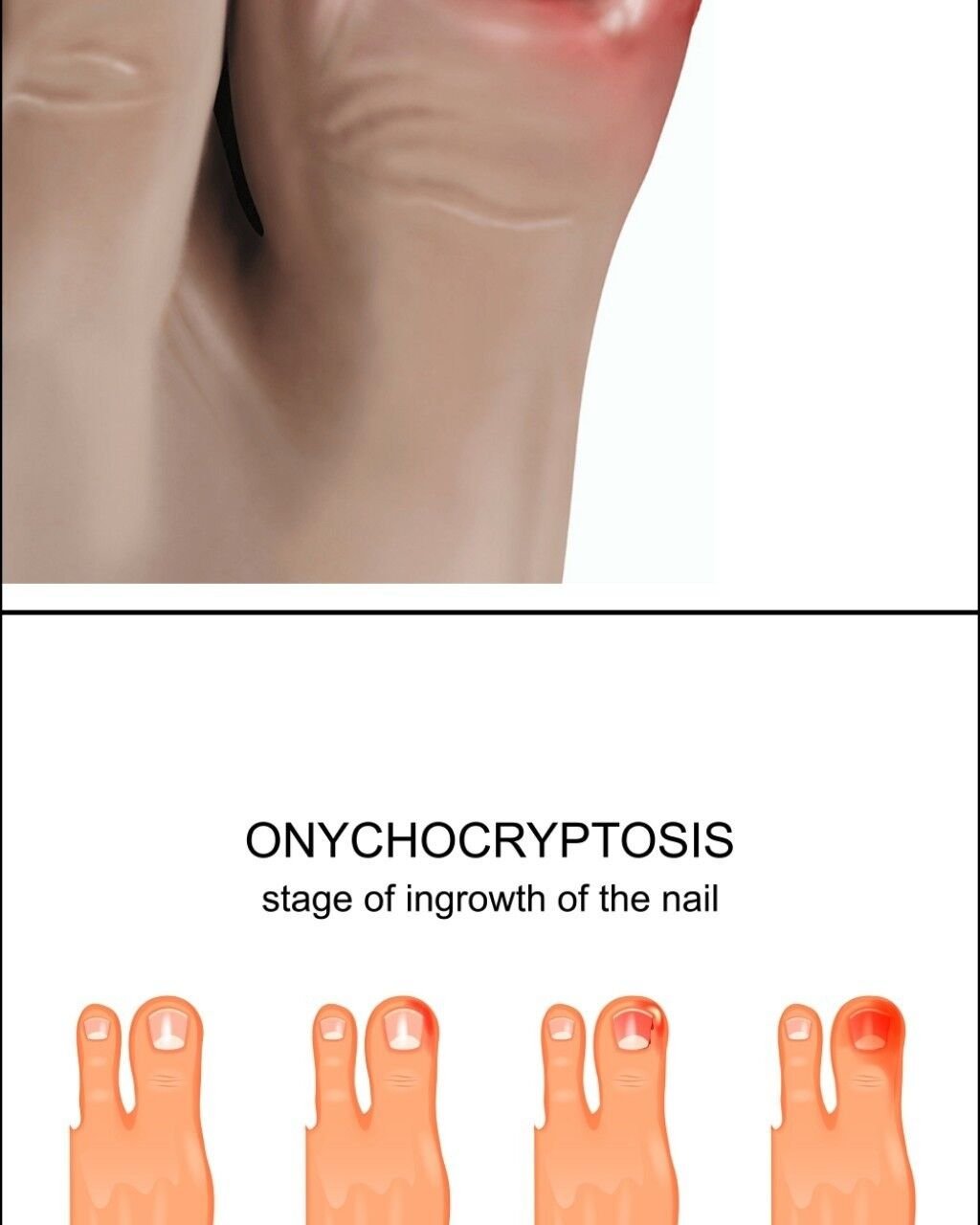 ما هو الظفر الناشب (Ingrowing Nail)؟