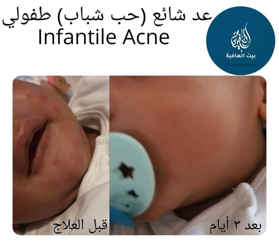 حب الشباب (Acne)