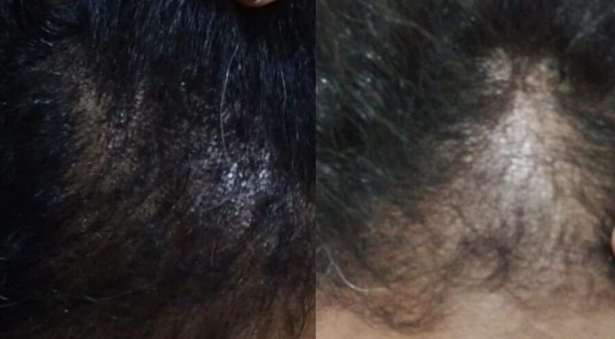 علاج مشاكل الشعر يحتاج مقاربة شاملة! 💇♀️✨