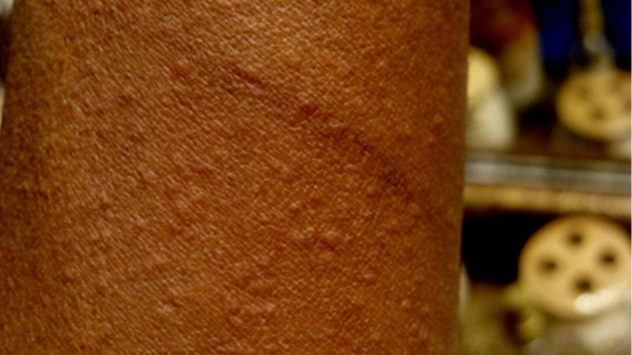 الشرى الكوليني (Cholinergic Urticaria):