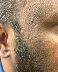 🔹 تصبغات النضوج (Maturational Hyperpigmentation) 🔹