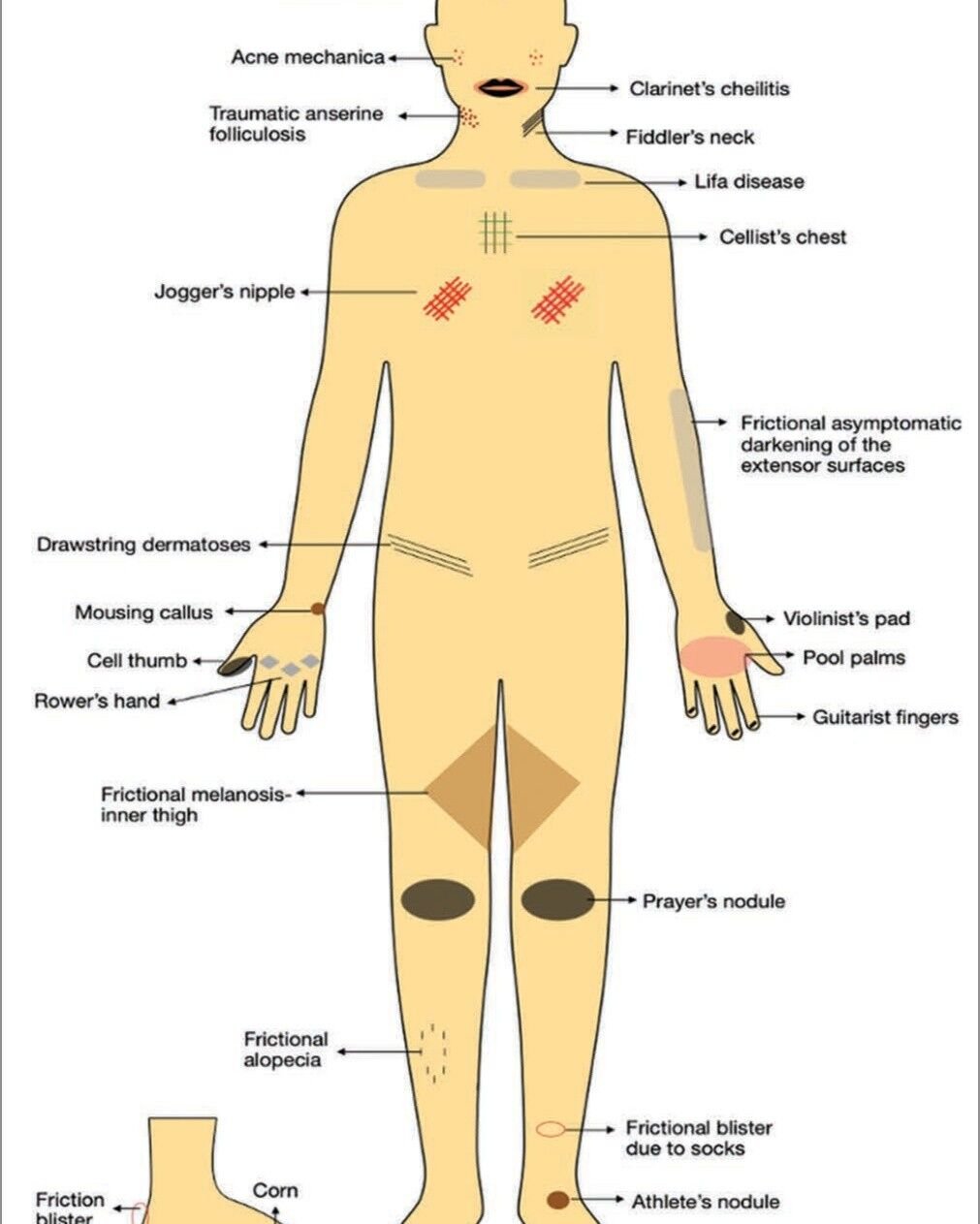 🔹 التصبغات الاحتكاكية (Frictional Melanosis) 🔹