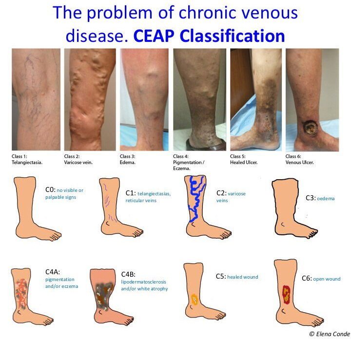 القصور الوريدي المزمن (Chronic Venous Insufficiency) — الجزء 1