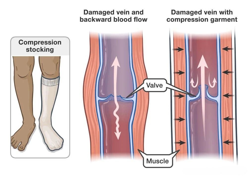 القصور الوريدي المزمن (Chronic Venous Insufficiency) — الجزء 4