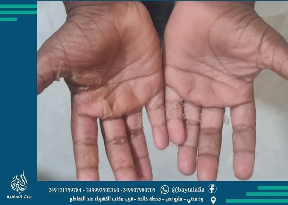 ظاهرة تقشر اليدين والأقدام