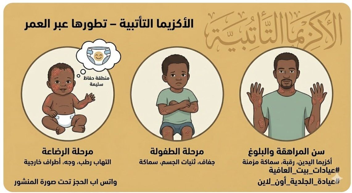 الاكزيما التأتبية – شكلها كيف وبتتطور كيف؟