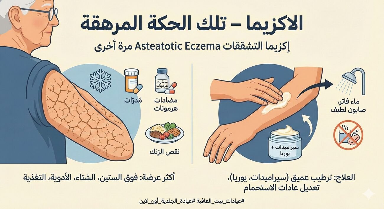 إكزيما التشققات Asteatotic Eczema مرة أخرى