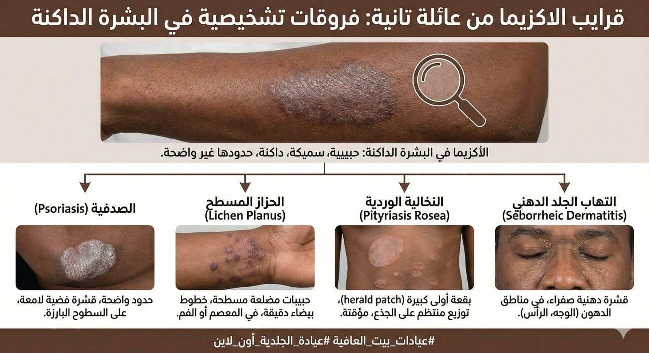 قرايب الاكزيما من عائلة تانية