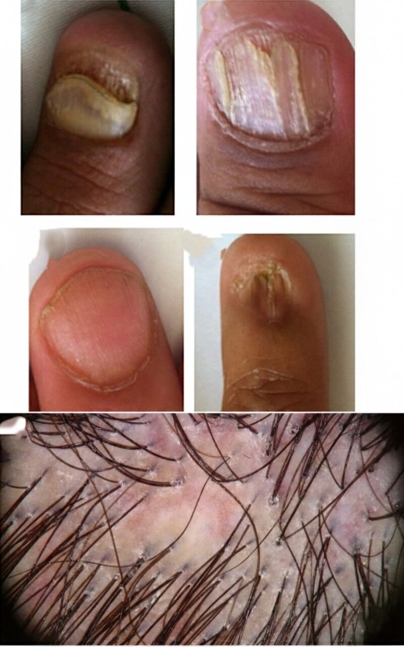 حزاز الشعر والأظافر