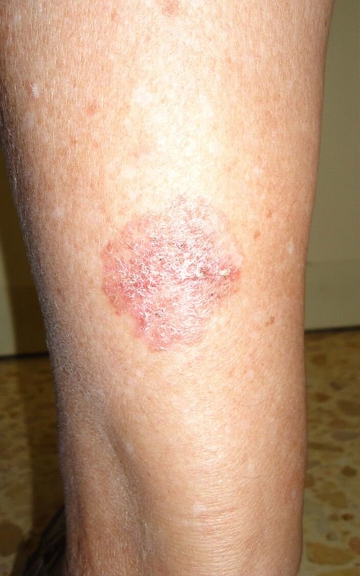 مرض بوين (Bowen’s Disease)