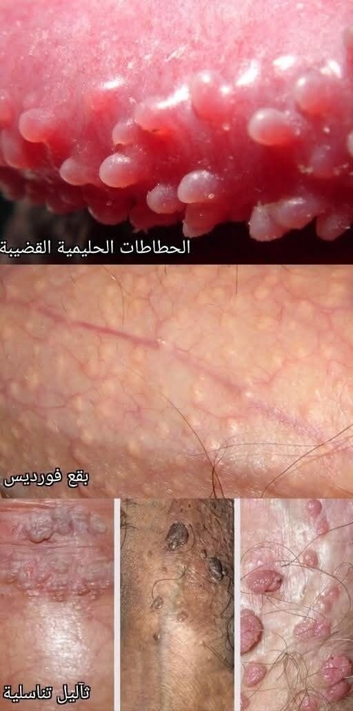 الفرق بين حطاطات (Papules)
