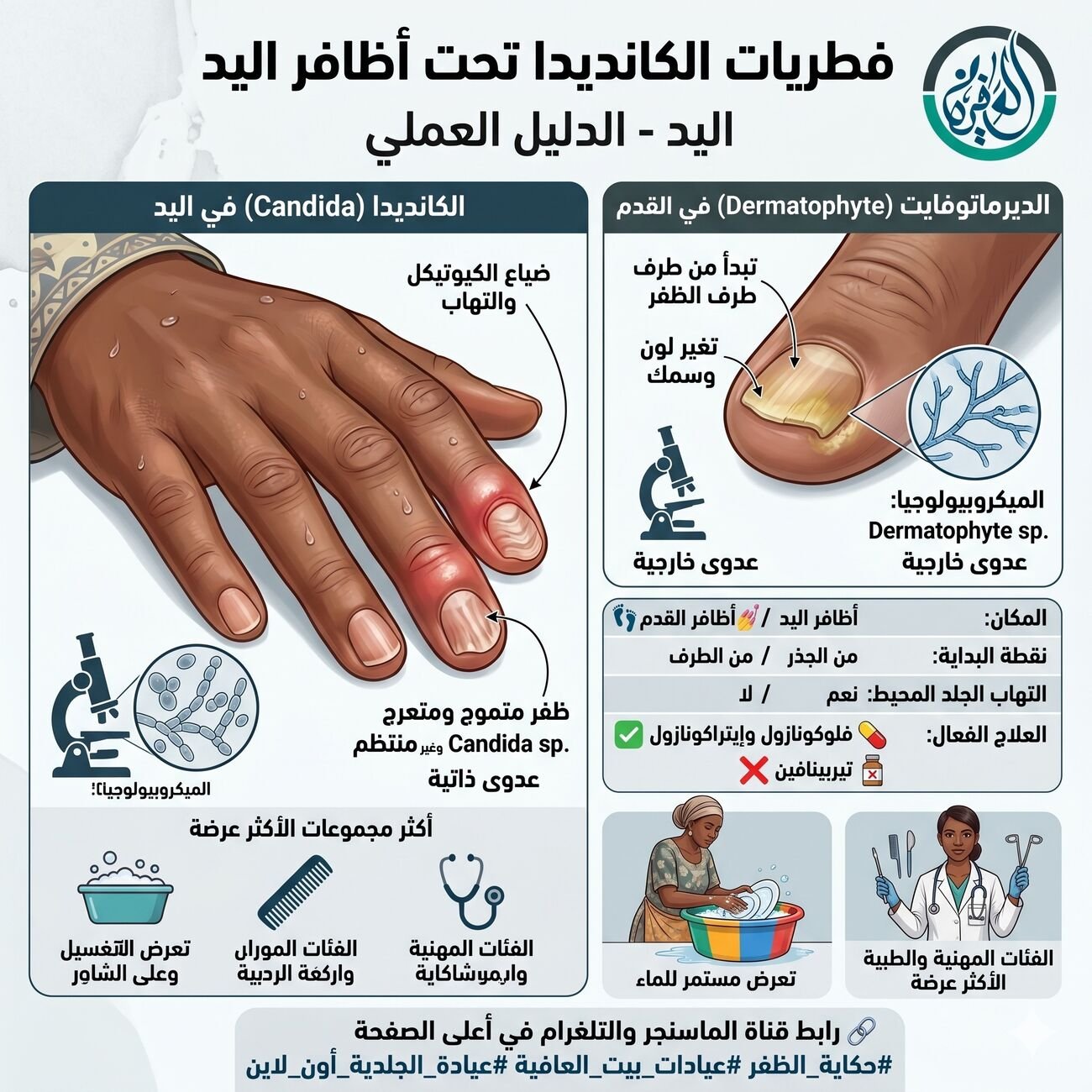 فطريات اللي يدها في الموية طول اليوم - الكانديدا تحت الظفر