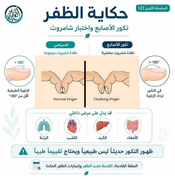 تكور الأصابع واختبار شامروث