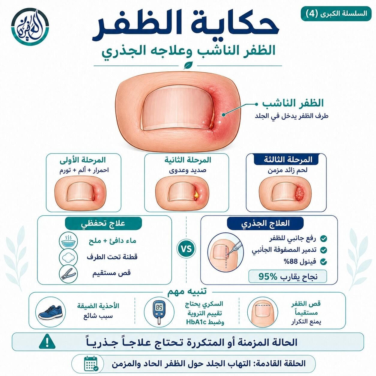 الظفر الناشب وعلاجو الجذري