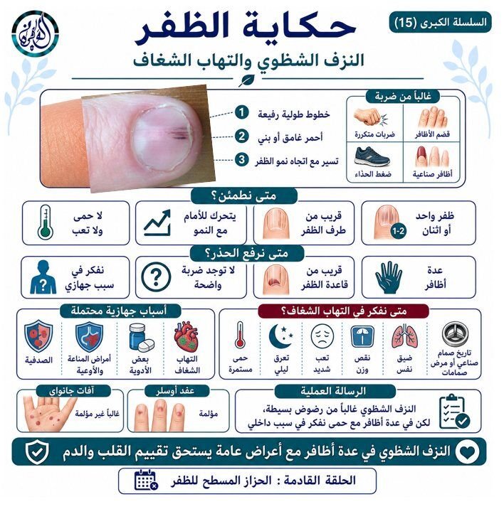 النزف الشظوي والتهاب الشغاف