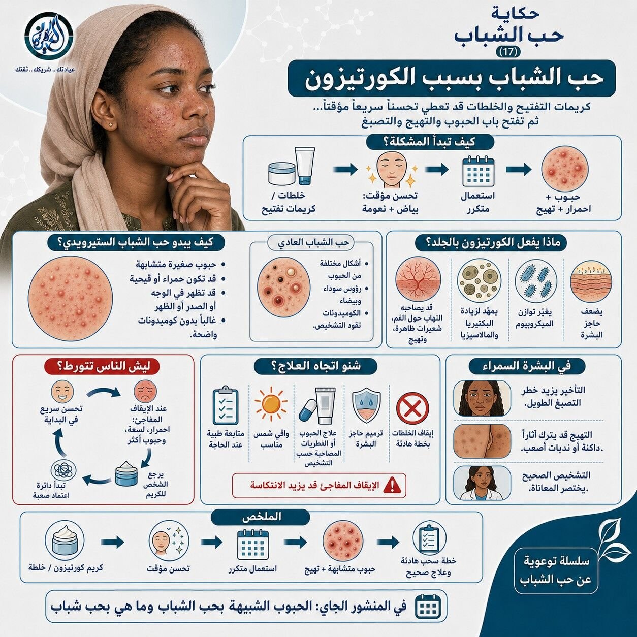 حب الشباب بسبب الكورتيزول