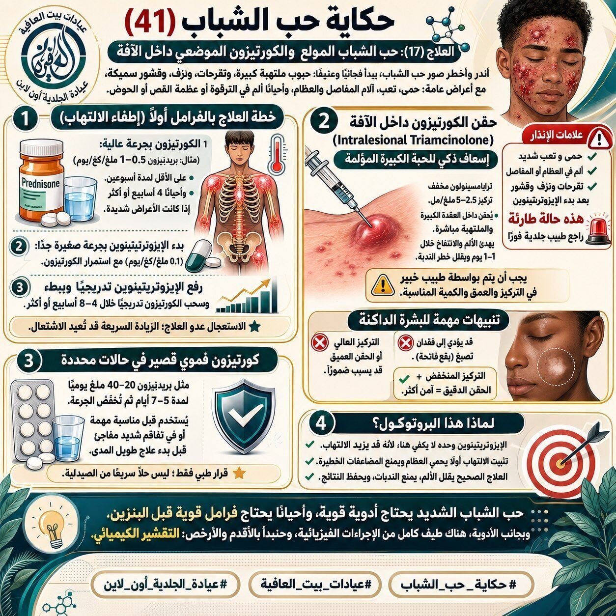 حب الشباب المولع والكورتيزون الموضعي داخل الآفة