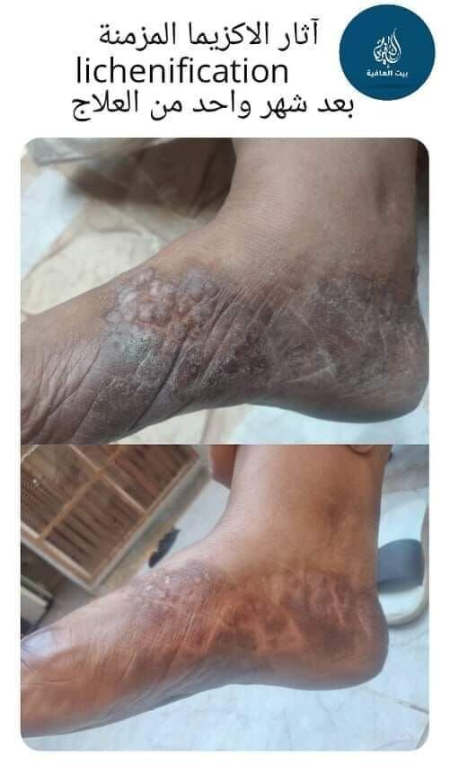 التحزز Lichenification هو رد فعل جلدي مبرمج يحدث كنتيجة للإحتكاك المتكرر، وربما يكون معروفا عند