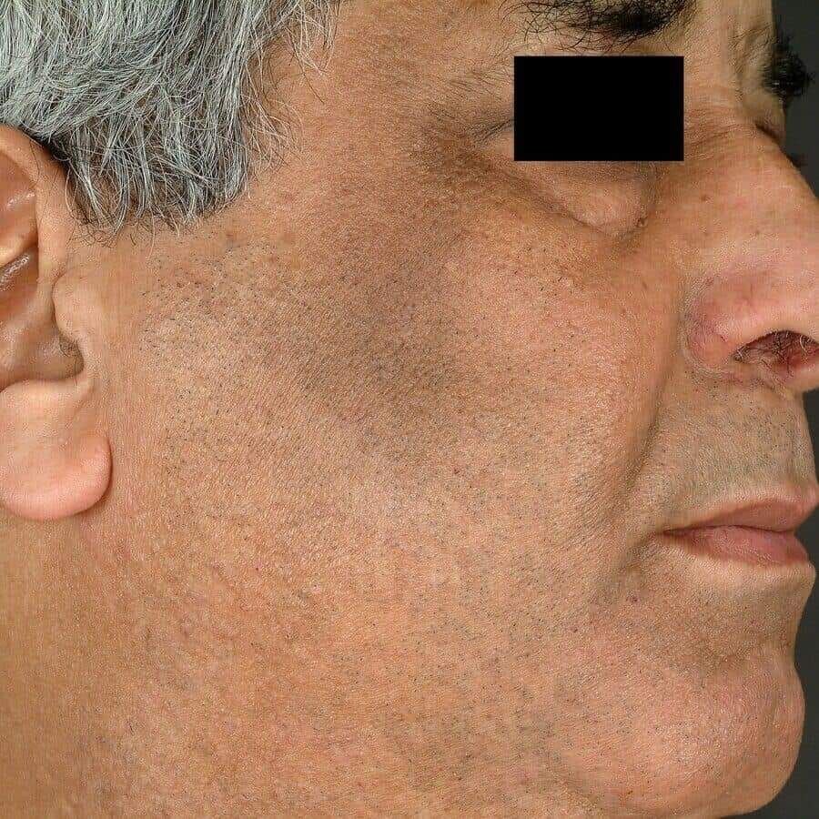 تصبغ/قتامينية رايل Riehl's Melanosis