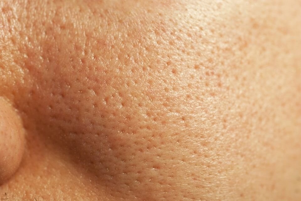 🌟 هل تعانين من مشكلة المسام الواسعة على وجهك؟ 🌟