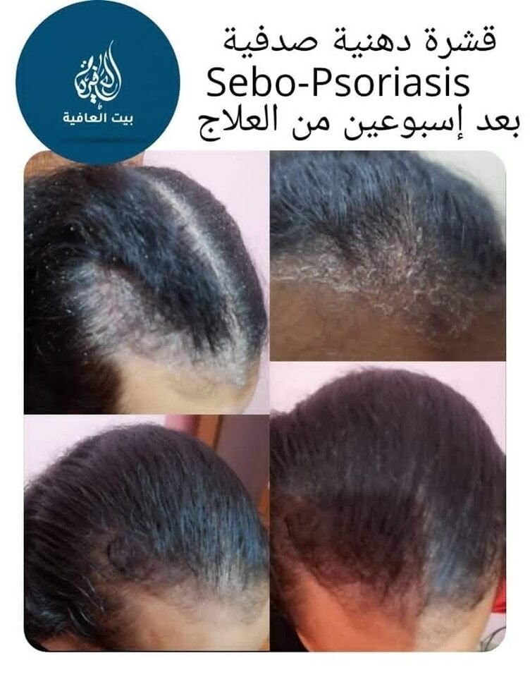 القشرة الدهنية الصدفية Sebo-Psoriasis من الأمراض التي يساء تشخيصها كقشرة عادية Dandruff أو أكزي