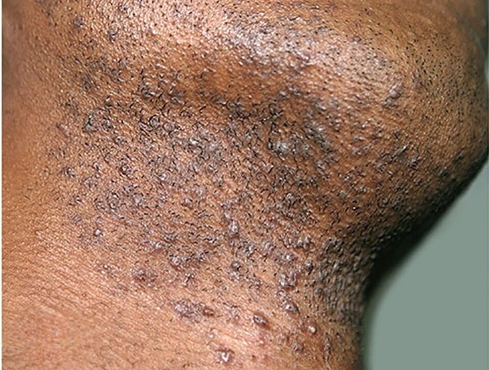 إرشادات وقائية للتعامل مع التهاب الجريبات الزائف باللحية Pseudo Folliculiti