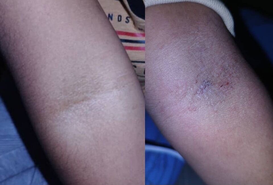 ✨✨ إكزيما الطيات Flexural Dermatitis