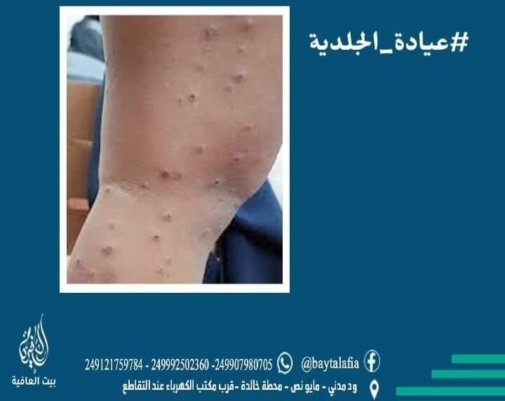 الارتكاريا الحبيبية Papular Urticaria