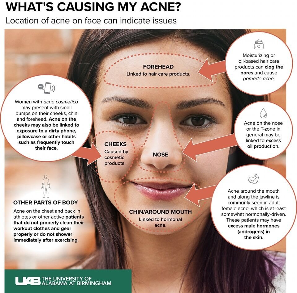 🌟 تفاقم حب الشباب Breakouts 🌟