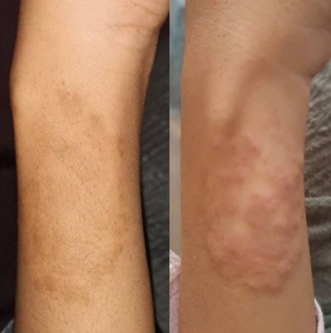 الفطريات بسبب العلاج الخاطيء Tinea Incognito
