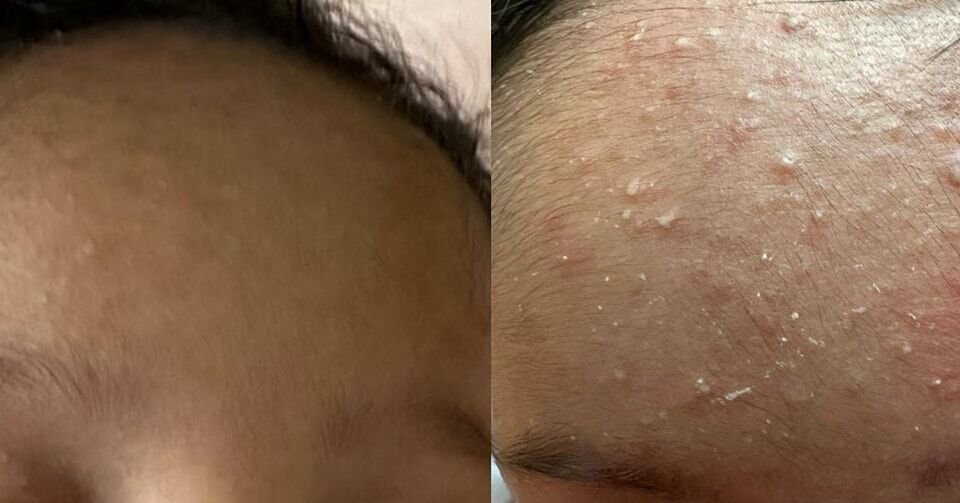 طب جلدية الأطفال (Pediatric Dermatology)