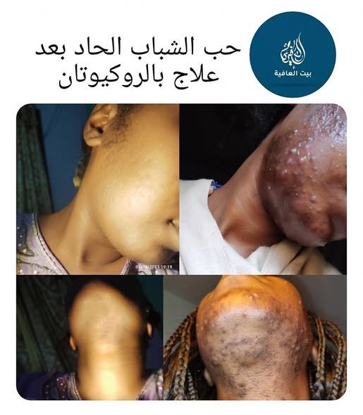 حب الشباب الحاد — بعد العلاج بالروكيوتان
