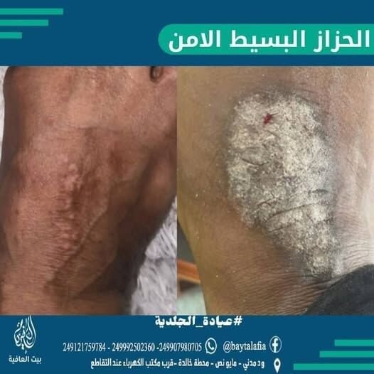 الحزاز البسيط المزمن — قبل وبعد العلاج