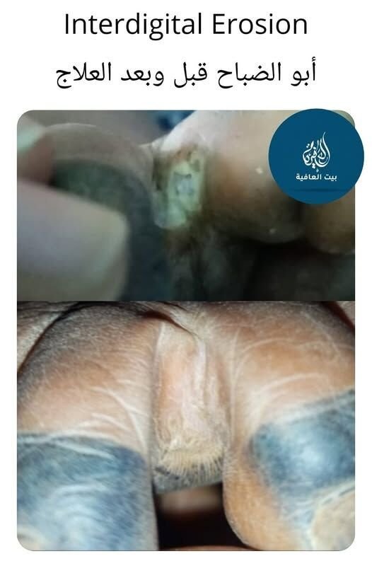 التآكل بين الأصابع (Interdigital Erosion) — قبل وبعد العلاج