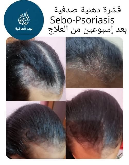 القشرة الدهنية الصدفية — بعد أسبوعين من العلاج