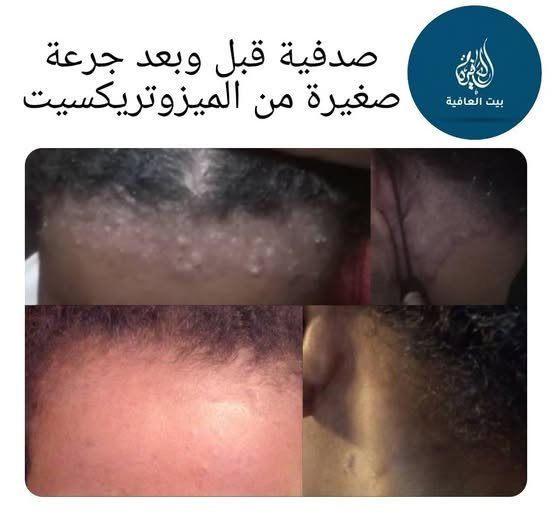 الصدفية — قبل وبعد العلاج