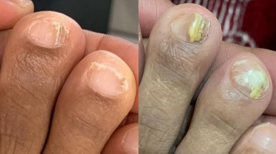 فطار أظافر القدم (Onychomycosis) — قبل وبعد العلاج